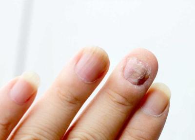 ناخن شما در مورد سلامت بدنتان چه می گوید؟ ناخن شما در مورد سلامت بدنتان چه می گوید؟